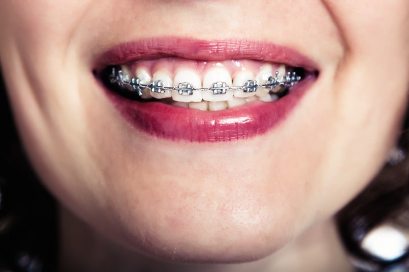 ¿Cuánto Cuestan Los Brackets En España?
